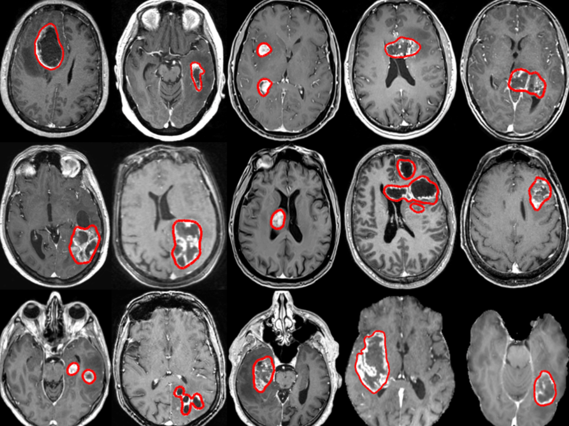 Enhanced Brain Tumor Detection With Xception: A Deep Learning Approach.
